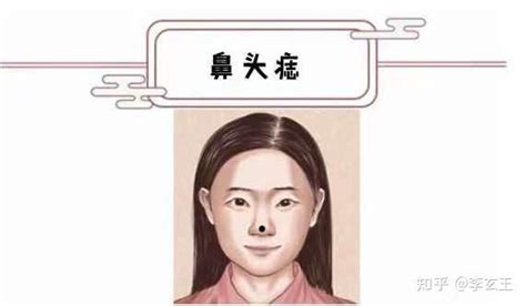 痦子位置解说图_痦子位置解说图女生,第17张