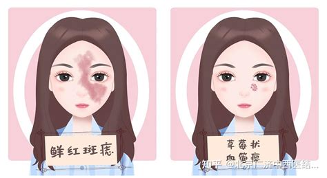 脖子上有胎记代表什么意思_脖子上有胎记有啥寓意,第12张 脖子上有胎记代表什么意思_脖子上有胎记有啥寓意,第12张