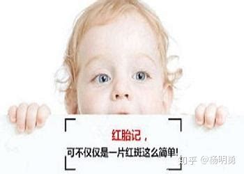 脖子上有胎记代表什么意思_脖子上有胎记有啥寓意,第7张 脖子上有胎记代表什么意思_脖子上有胎记有啥寓意,第7张