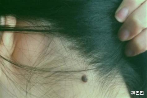 脖子上有胎记代表什么意思_脖子上有胎记有啥寓意,第13张 脖子上有胎记代表什么意思_脖子上有胎记有啥寓意,第13张