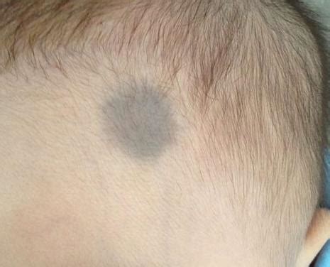 大腿上有胎记代表什么_大腿上有胎记好不好,第11张 大腿上有胎记代表什么_大腿上有胎记好不好,第11张