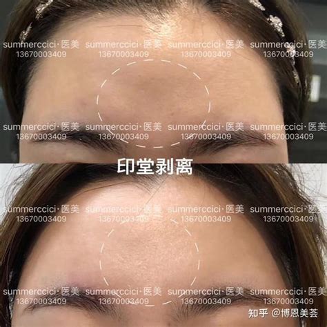 印堂在什么位置_印堂在什么位置发红,第8张 印堂在什么位置_印堂在什么位置发红,第8张