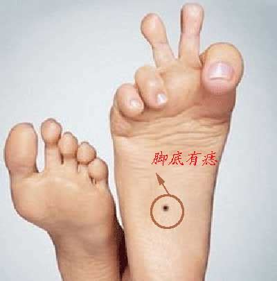 脚掌有痣是什么意思_脚掌有痣意味着啥,第5张