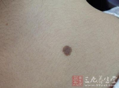 后背脊柱中间长痣代表什么_后脊柱中间有痣是什么意义,第12张