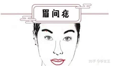 女人脸上长痣图片_女人脸上长痣图片面相,第18张 女人脸上长痣图片_女人脸上长痣图片面相,第18张