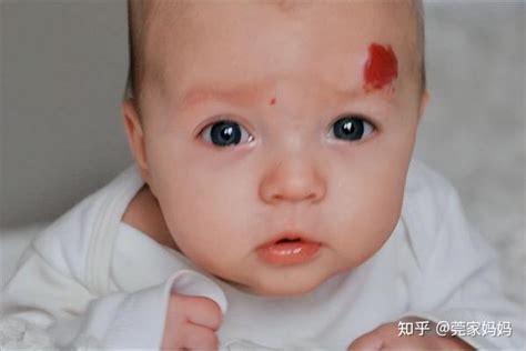 大腿上有胎记代表什么_大腿上有胎记好不好,第15张