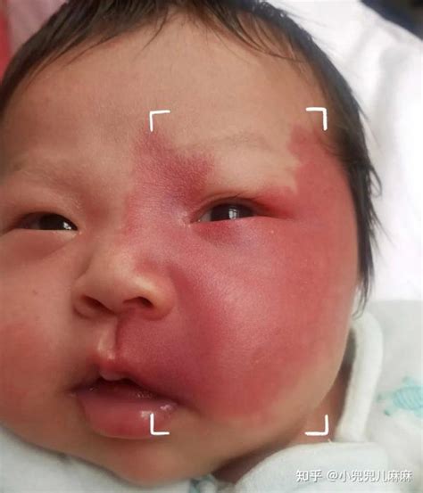 大腿上有胎记代表什么_大腿上有胎记好不好,第17张 大腿上有胎记代表什么_大腿上有胎记好不好,第17张