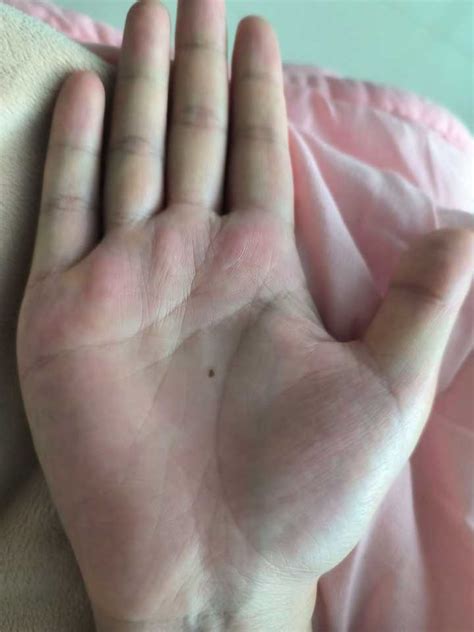 双眼皮夹缝里长一颗痣好不好_双眼皮夹缝里长一颗痣要点掉吗,第3张