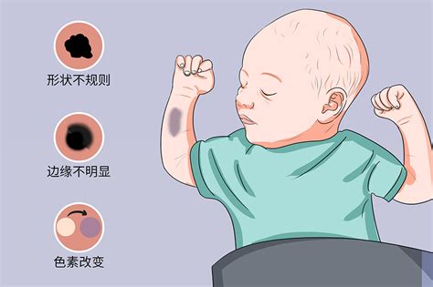 胎记有哪些颜色和类型_胎记分为几种类型,第2张