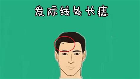 藏在发际线的痣男人_藏在发际线的痣容易恶变吗,第2张