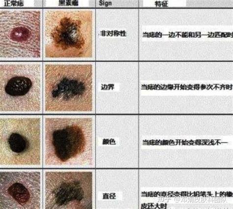 脸上哪些痣不能去掉示意图_脸上哪些痣必须点掉图解,第3张 脸上哪些痣不能去掉示意图_脸上哪些痣必须点掉图解,第3张