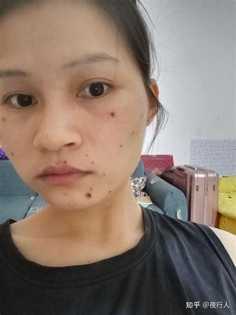 右手虎口有痣的女生姻缘_右手虎口有痣的女生跟左手虎口有痣的男生,第15张 右手虎口有痣的女生姻缘_右手虎口有痣的女生跟左手虎口有痣的男生,第15张