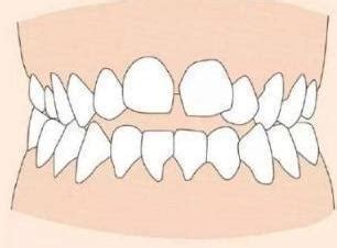 门牙有缝隙的人会漏财吗_门牙有缝隙会不会漏财,第5张