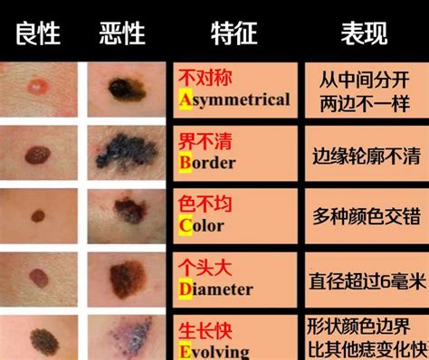 脸上哪些痣不能去掉示意图_脸上哪些痣必须点掉图解,第6张 脸上哪些痣不能去掉示意图_脸上哪些痣必须点掉图解,第6张