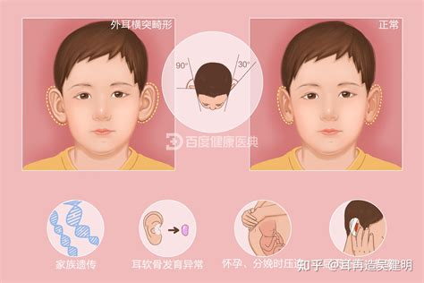 招风耳好不好_男孩长了一堆招风耳好不好,第9张