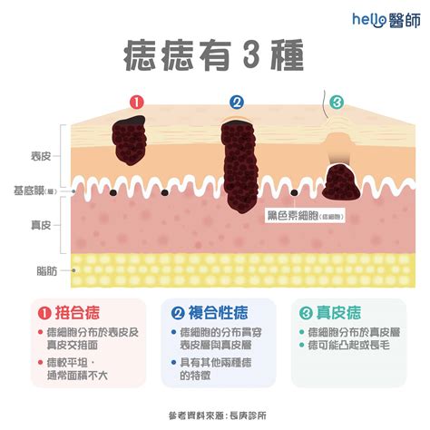 足部痣相图解女人_足部痣相右,第10张