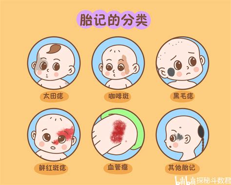 胎记有哪些颜色和类型_胎记分为几种类型,第9张 胎记有哪些颜色和类型_胎记分为几种类型,第9张
