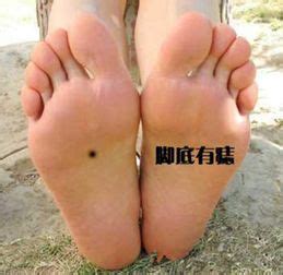 脚上长痣图解大全_脚上长痣图解大全女性,第8张 脚上长痣图解大全_脚上长痣图解大全女性,第8张